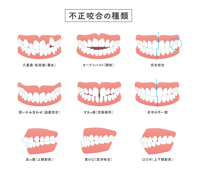 西葛西の歯医者、まさき歯科クリニックの小児矯正歯科