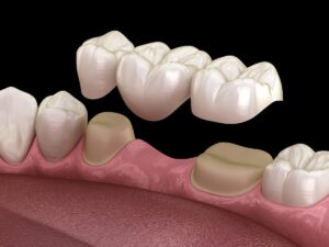 西葛西の歯医者、まさき歯科クリニックのブリッジ